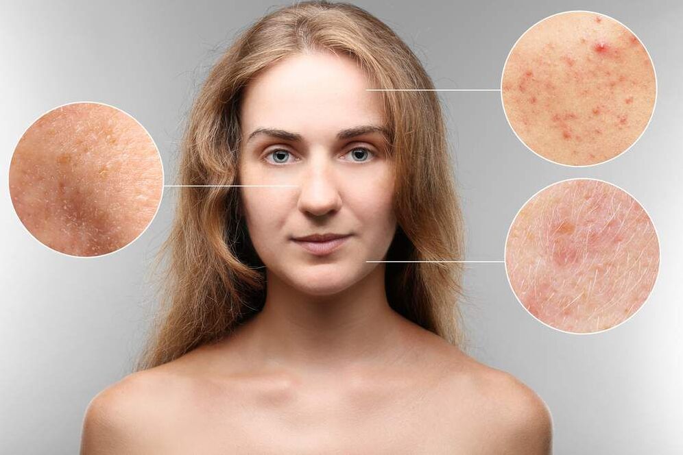 rash on the face due to parasites